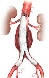 Vascular graphic